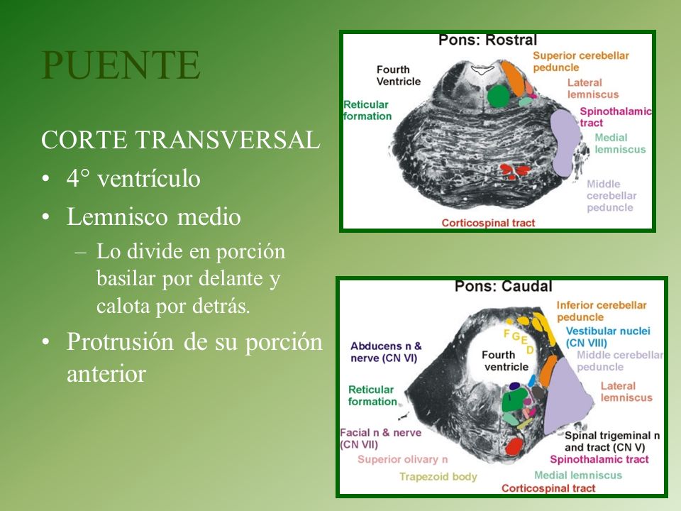 PUENTE CORTE TRANSVERSAL 4° ventrículo Lemnisco medio
