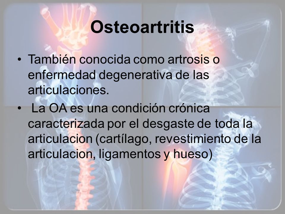 Osteoartritis También conocida como artrosis o enfermedad degenerativa de las articulaciones.