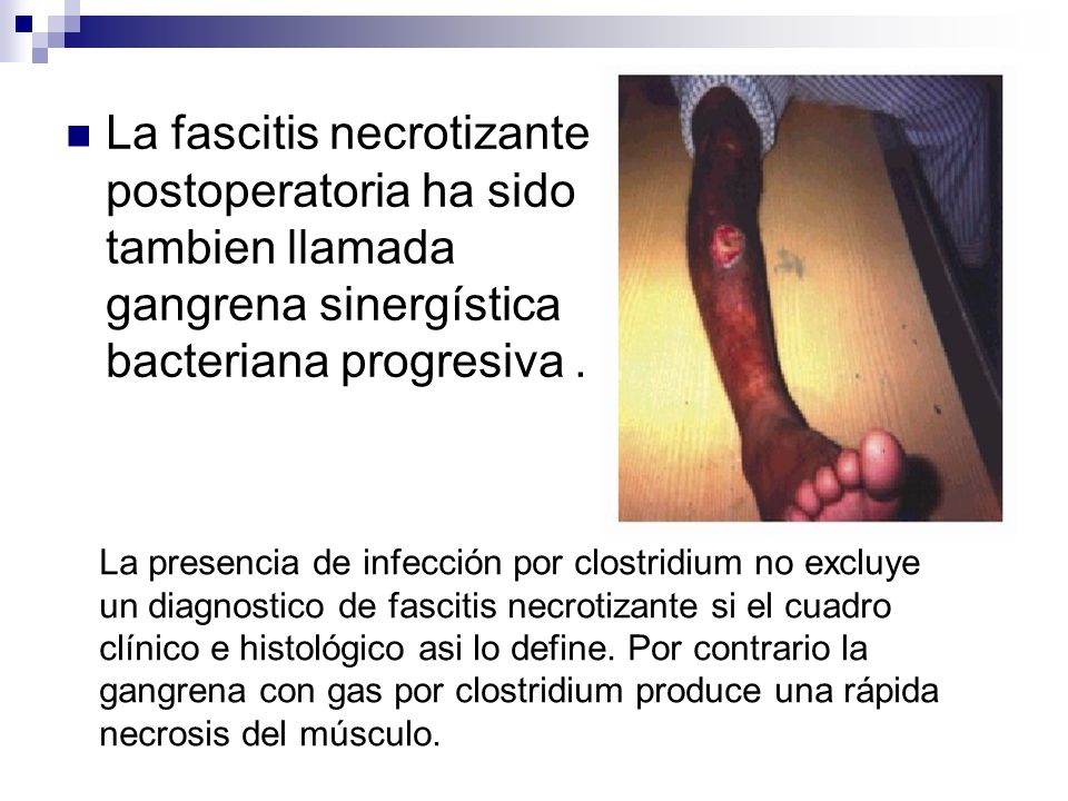 La fascitis necrotizante postoperatoria ha sido tambien llamada gangrena sinergística bacteriana progresiva .