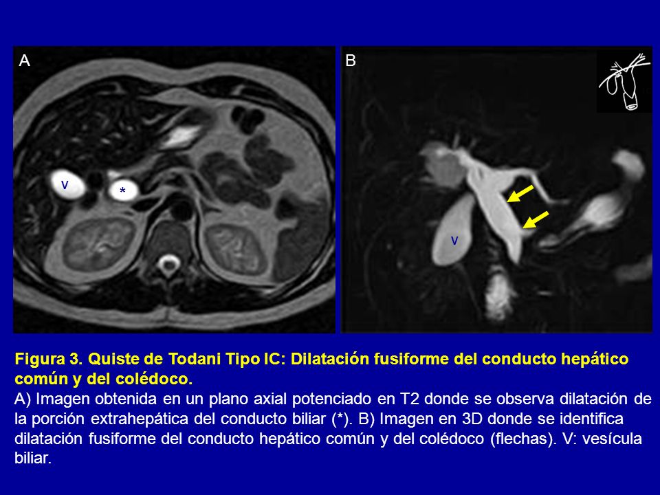 A B. V. * V. Figura 3. Quiste de Todani Tipo IC: Dilatación fusiforme del conducto hepático común y del colédoco.
