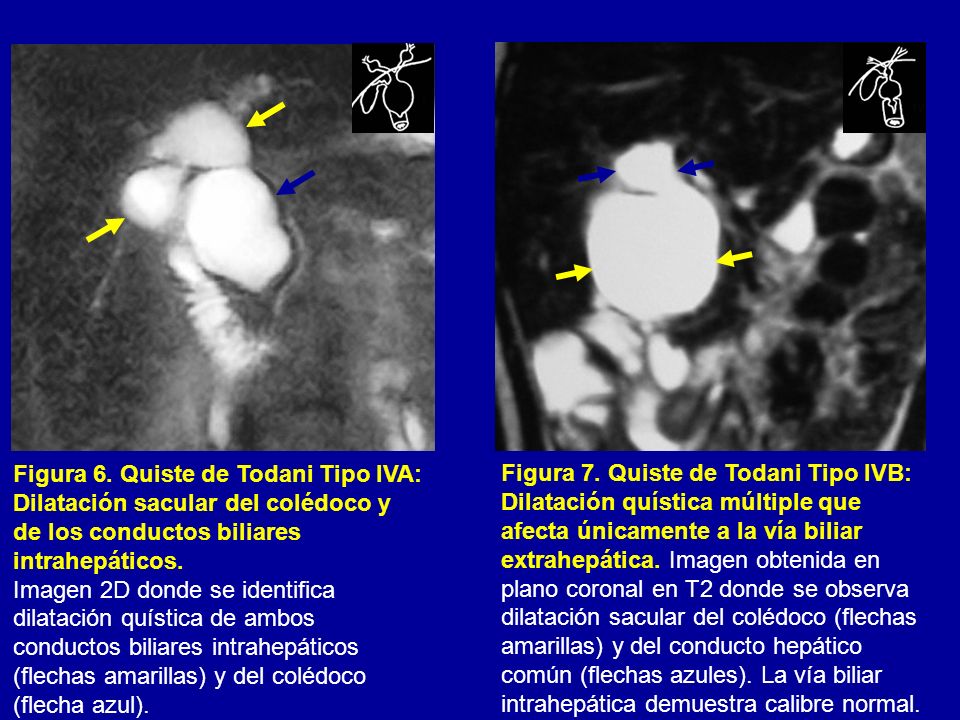 Figura 6. Quiste de Todani Tipo IVA: Dilatación sacular del colédoco y de los conductos biliares intrahepáticos.