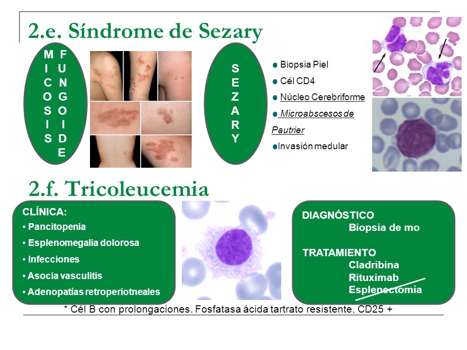 2.e. Síndrome de Sezary 2.f. Tricoleucemia M F I U C N O G S O I I S D