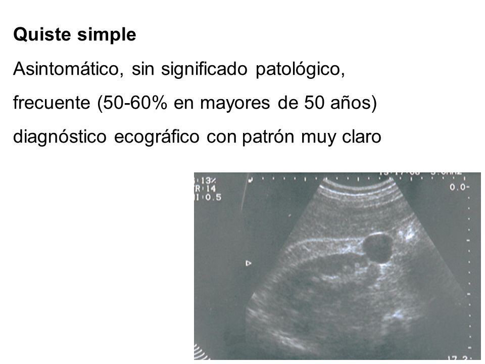 Quiste simple Asintomático, sin significado patológico, frecuente (50-60% en mayores de 50 años) diagnóstico ecográfico con patrón muy claro.