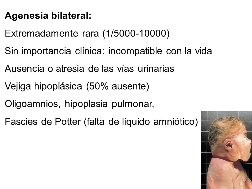 Agenesia bilateral: Extremadamente rara (1/ ) Sin importancia clínica: incompatible con la vida.