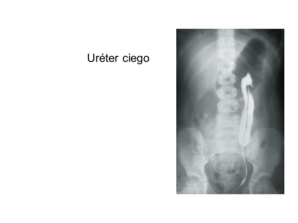 Uréter ciego