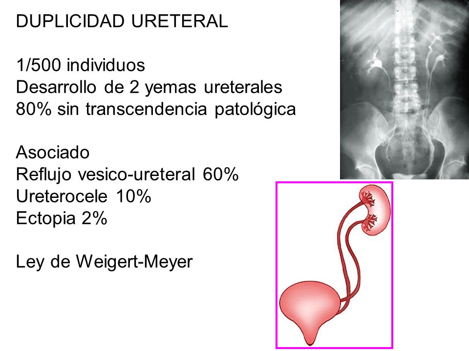 DUPLICIDAD URETERAL 1/500 individuos. Desarrollo de 2 yemas ureterales. 80% sin transcendencia patológica.