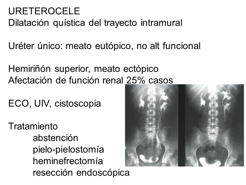 URETEROCELE Dilatación quística del trayecto intramural. Uréter único: meato eutópico, no alt funcional.