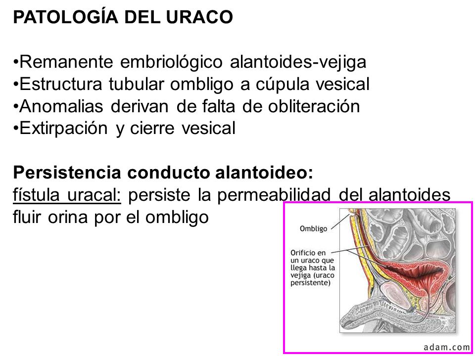 PATOLOGÍA DEL URACO Remanente embriológico alantoides-vejiga. Estructura tubular ombligo a cúpula vesical.