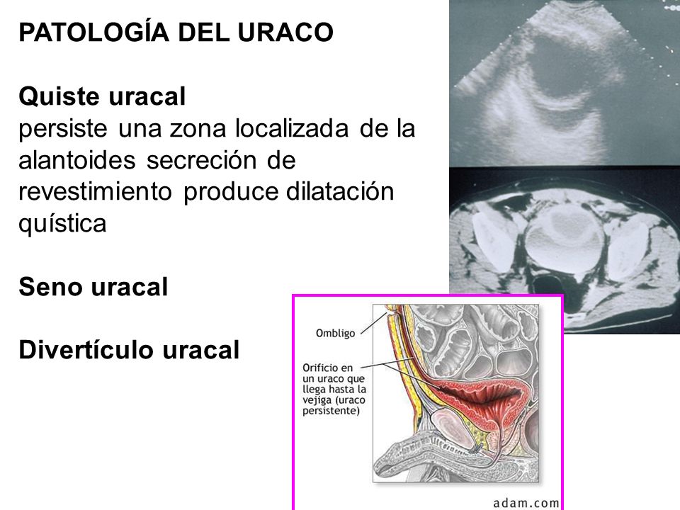PATOLOGÍA DEL URACO Quiste uracal. persiste una zona localizada de la. alantoides secreción de. revestimiento produce dilatación.
