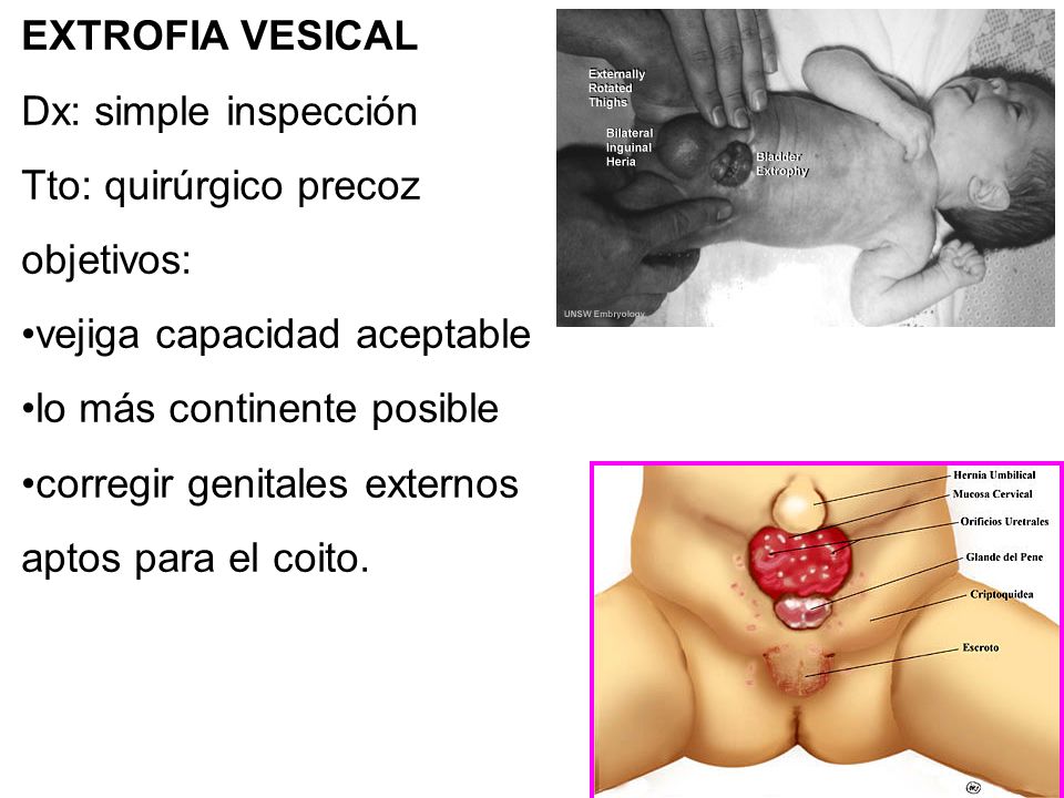 EXTROFIA VESICAL Dx: simple inspección. Tto: quirúrgico precoz. objetivos: vejiga capacidad aceptable.