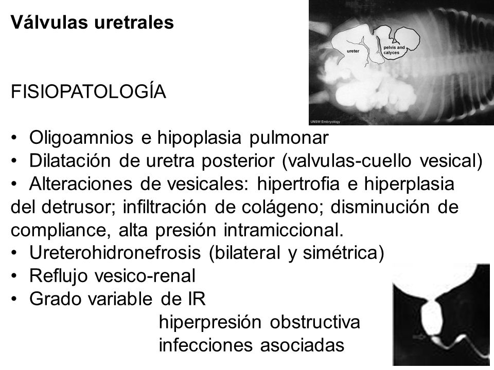 Válvulas uretrales FISIOPATOLOGÍA. Oligoamnios e hipoplasia pulmonar. Dilatación de uretra posterior (valvulas-cuello vesical)