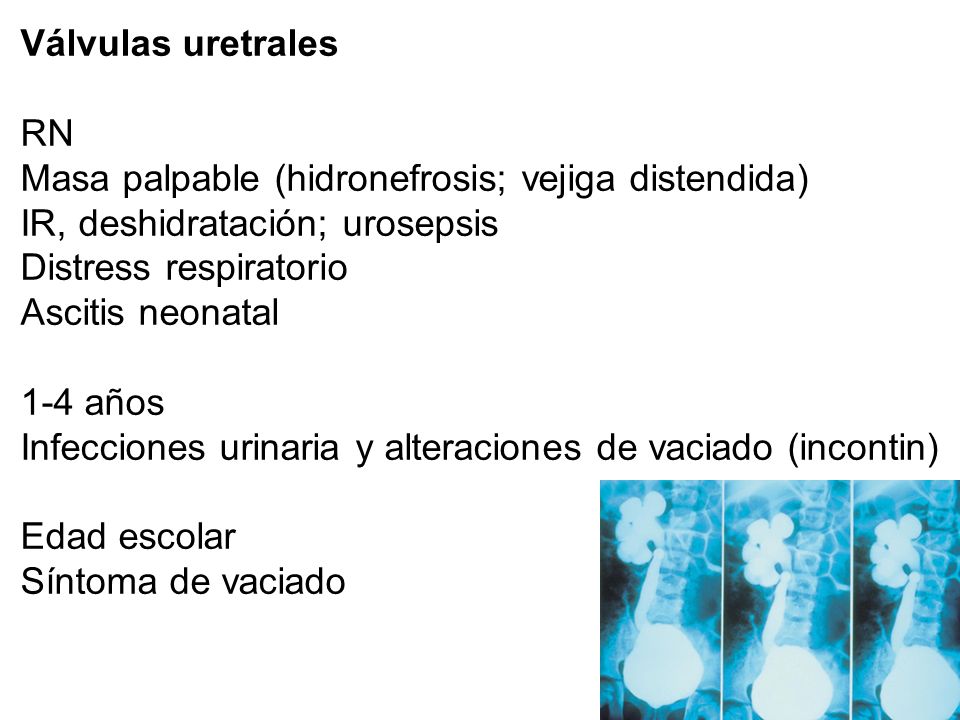 Válvulas uretrales RN. Masa palpable (hidronefrosis; vejiga distendida) IR, deshidratación; urosepsis.