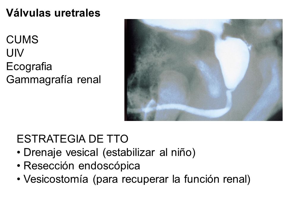 Válvulas uretrales CUMS. UIV. Ecografia. Gammagrafía renal. ESTRATEGIA DE TTO. Drenaje vesical (estabilizar al niño)