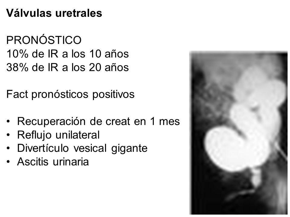 Válvulas uretrales PRONÓSTICO. 10% de IR a los 10 años. 38% de IR a los 20 años. Fact pronósticos positivos.