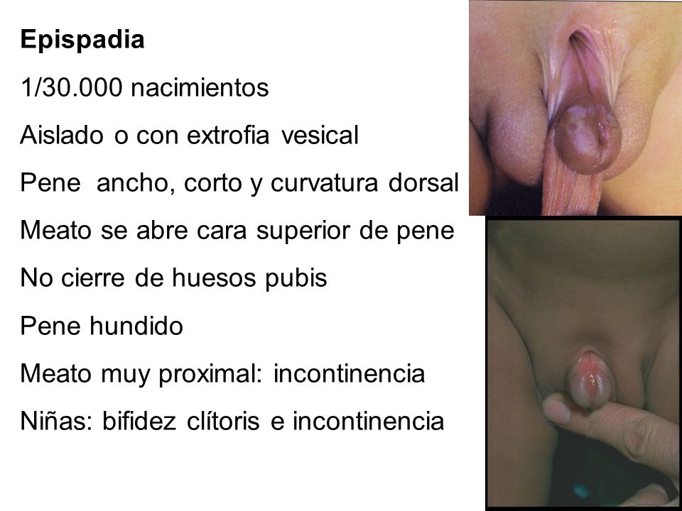 Aislado o con extrofia vesical Pene ancho, corto y curvatura dorsal