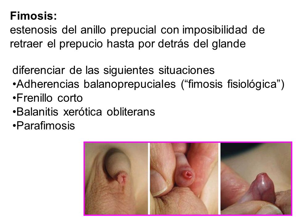 Fimosis: estenosis del anillo prepucial con imposibilidad de. retraer el prepucio hasta por detrás del glande.