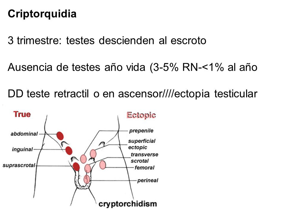 Criptorquidia 3 trimestre: testes descienden al escroto. Ausencia de testes año vida (3-5% RN-<1% al año.