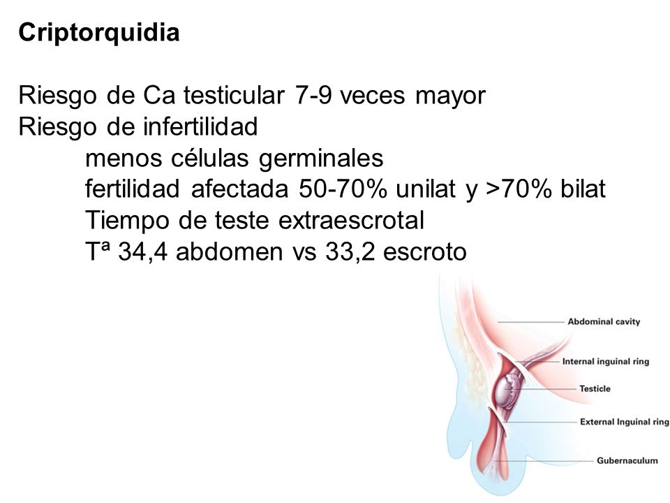 Criptorquidia Riesgo de Ca testicular 7-9 veces mayor. Riesgo de infertilidad. menos células germinales.