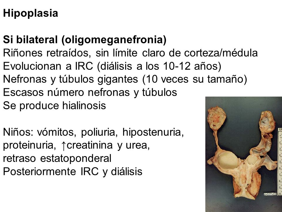 Hipoplasia Si bilateral (oligomeganefronia) Riñones retraídos, sin límite claro de corteza/médula.