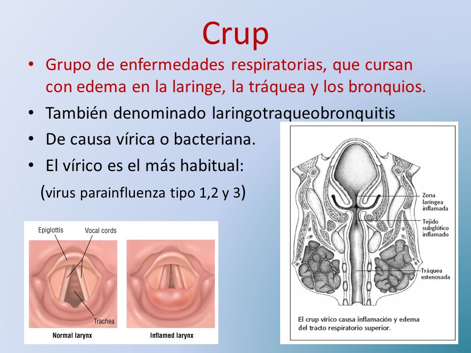 Crup Grupo de enfermedades respiratorias, que cursan con edema en la laringe, la tráquea y los bronquios.