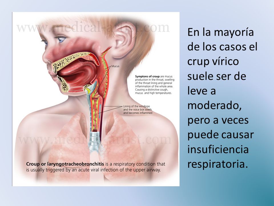 En la mayoría de los casos el crup vírico suele ser de leve a moderado, pero a veces puede causar insuficiencia