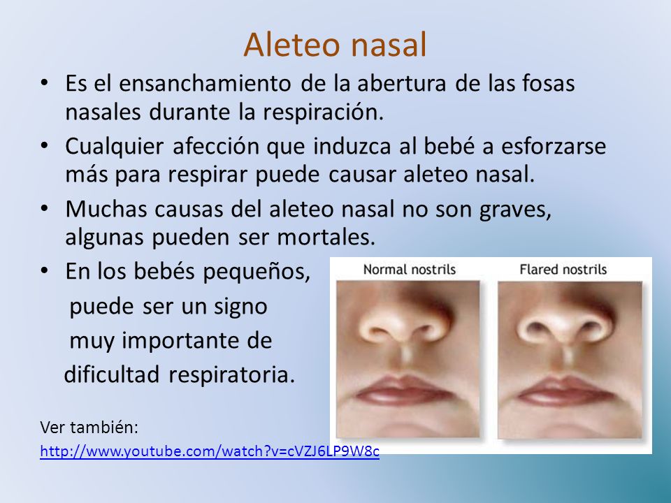 Aleteo nasal Es el ensanchamiento de la abertura de las fosas nasales durante la respiración.