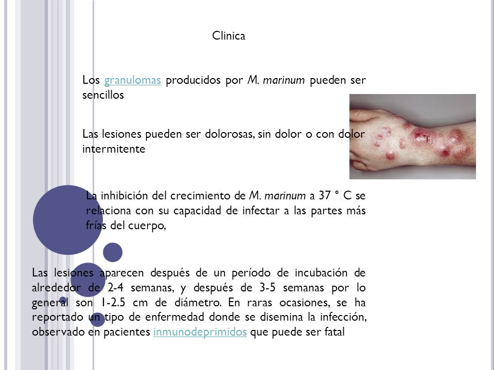 Clinica Los granulomas producidos por M. marinum pueden ser sencillos. Las lesiones pueden ser dolorosas, sin dolor o con dolor intermitente.