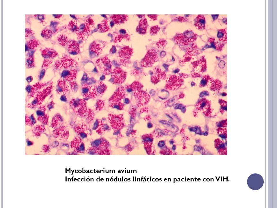 Mycobacterium avium Infección de nódulos linfáticos en paciente con VIH.