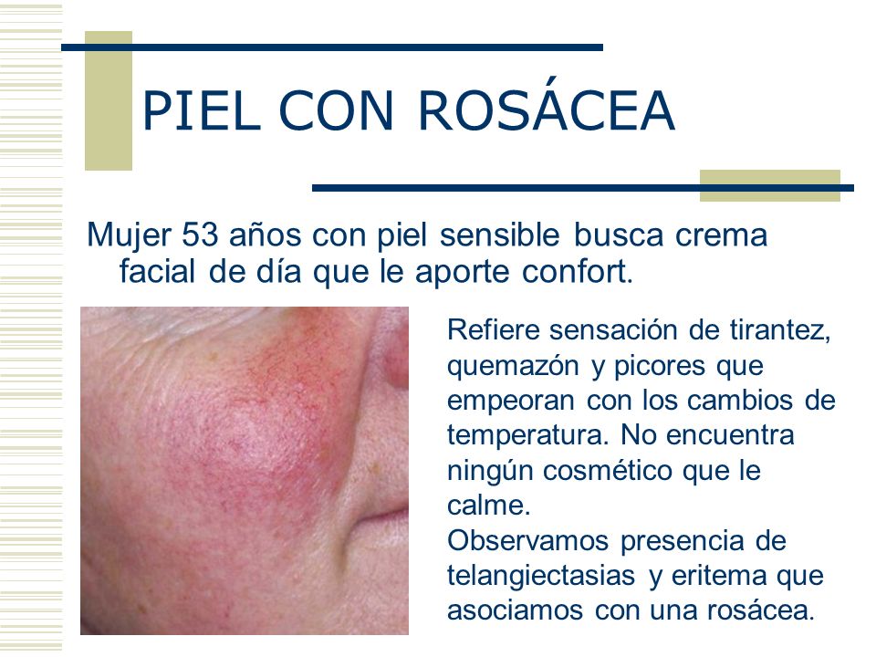 PIEL CON ROSÁCEA Mujer 53 años con piel sensible busca crema facial de día que le aporte confort.