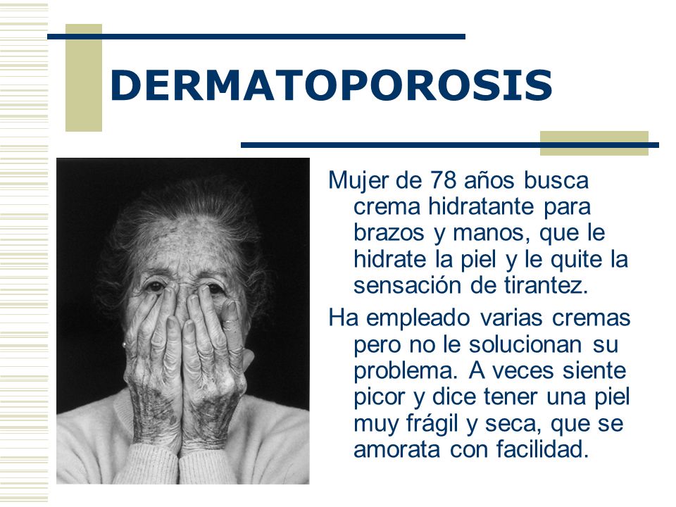 DERMATOPOROSIS Mujer de 78 años busca crema hidratante para brazos y manos, que le hidrate la piel y le quite la sensación de tirantez.