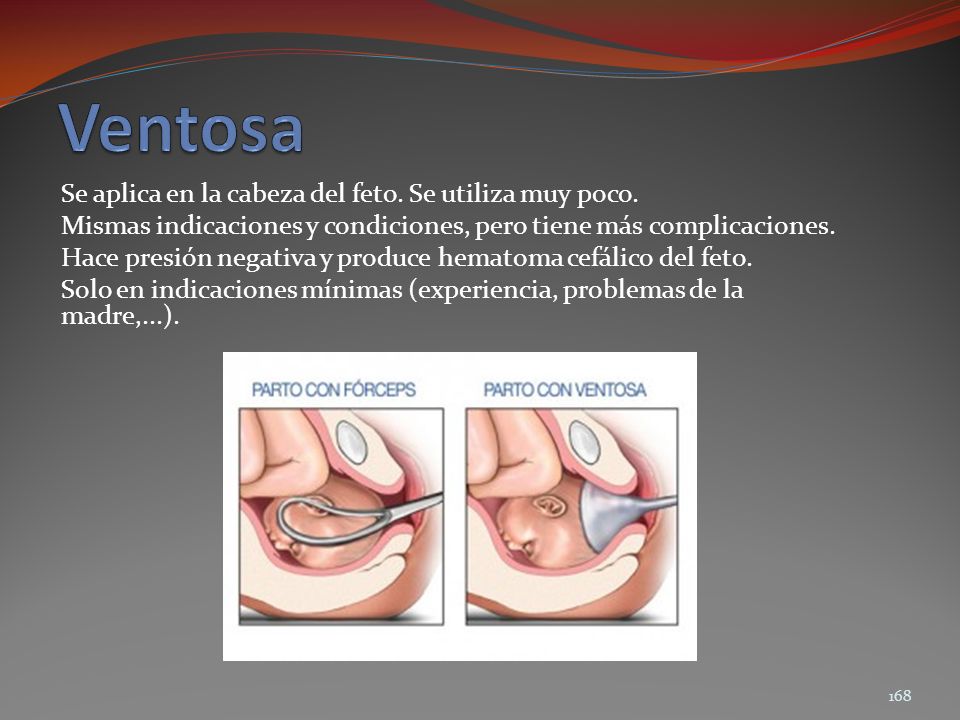 Ventosa Se aplica en la cabeza del feto. Se utiliza muy poco.
