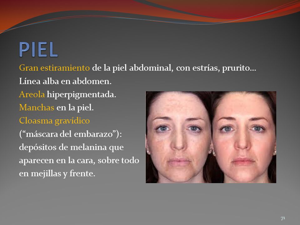 PIEL Gran estiramiento de la piel abdominal, con estrías, prurito…