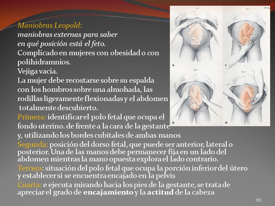 Maniobras Leopold: maniobras externas para saber. en qué posición está el feto. Complicado en mujeres con obesidad o con.