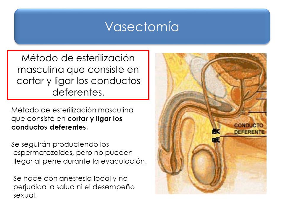 Vasectomía Método de esterilización masculina que consiste en cortar y ligar los conductos deferentes.