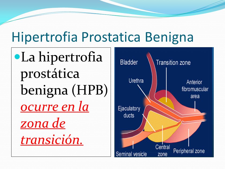 hipertrofia prostatica benigna icd 10 ura, am vindecat prostatita