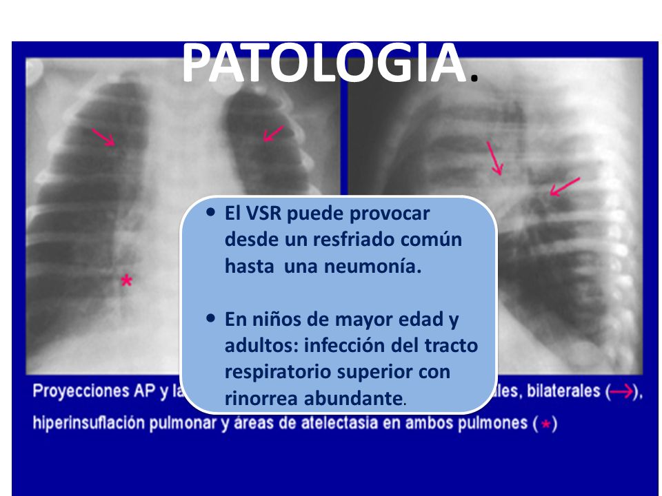 PATOLOGIA. El VSR puede provocar desde un resfriado común hasta una neumonía.