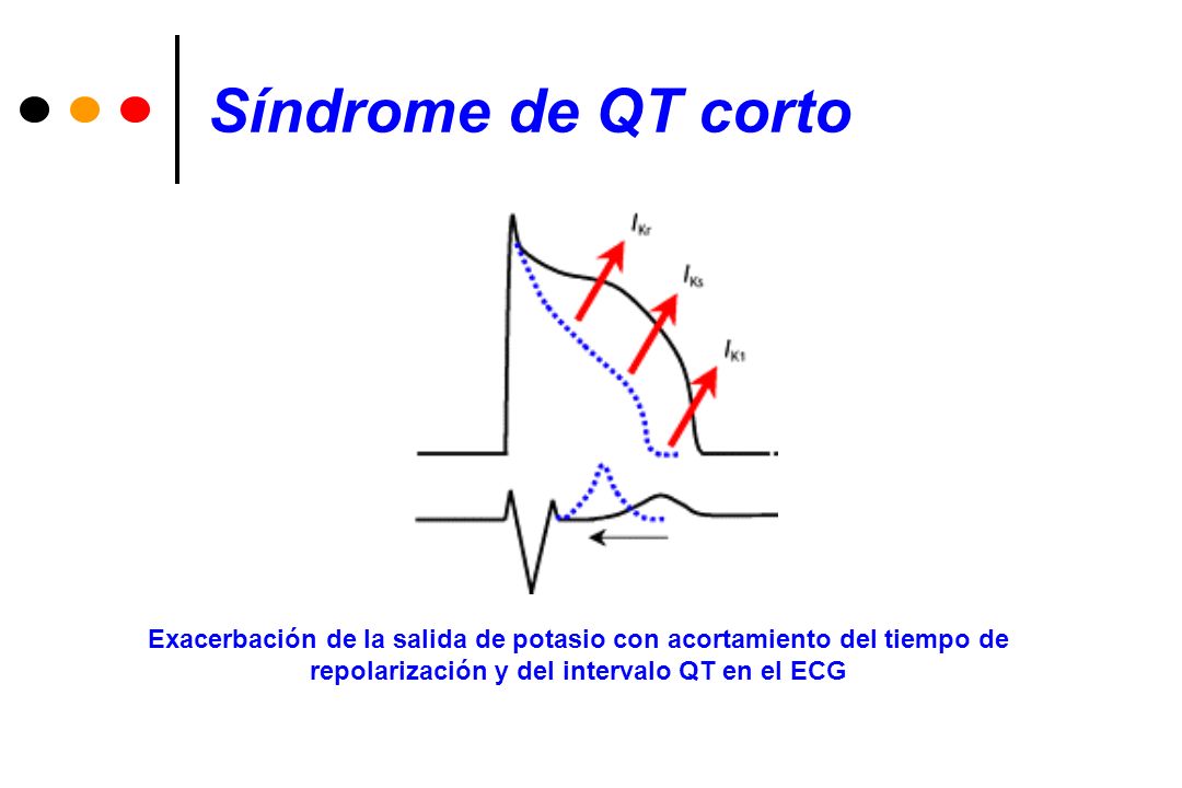 Síndrome de QT corto Exacerbación de la salida de potasio con acortamiento del tiempo de.
