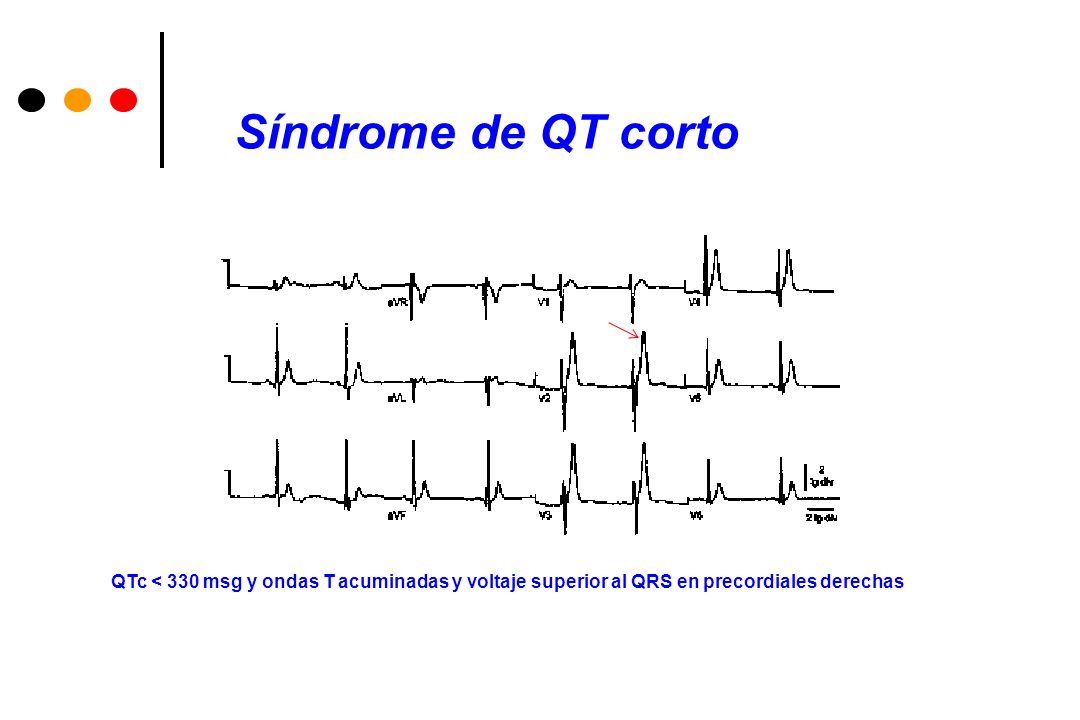 Síndrome de QT corto QTc < 330 msg y ondas T acuminadas y voltaje superior al QRS en precordiales derechas.