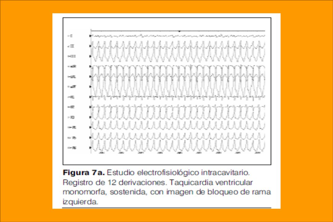 INTRODUCCION La displasia arritmogénica de ventrículo derecho (DAVD) es una miocardiopatía en la cual el miocárdico es.
