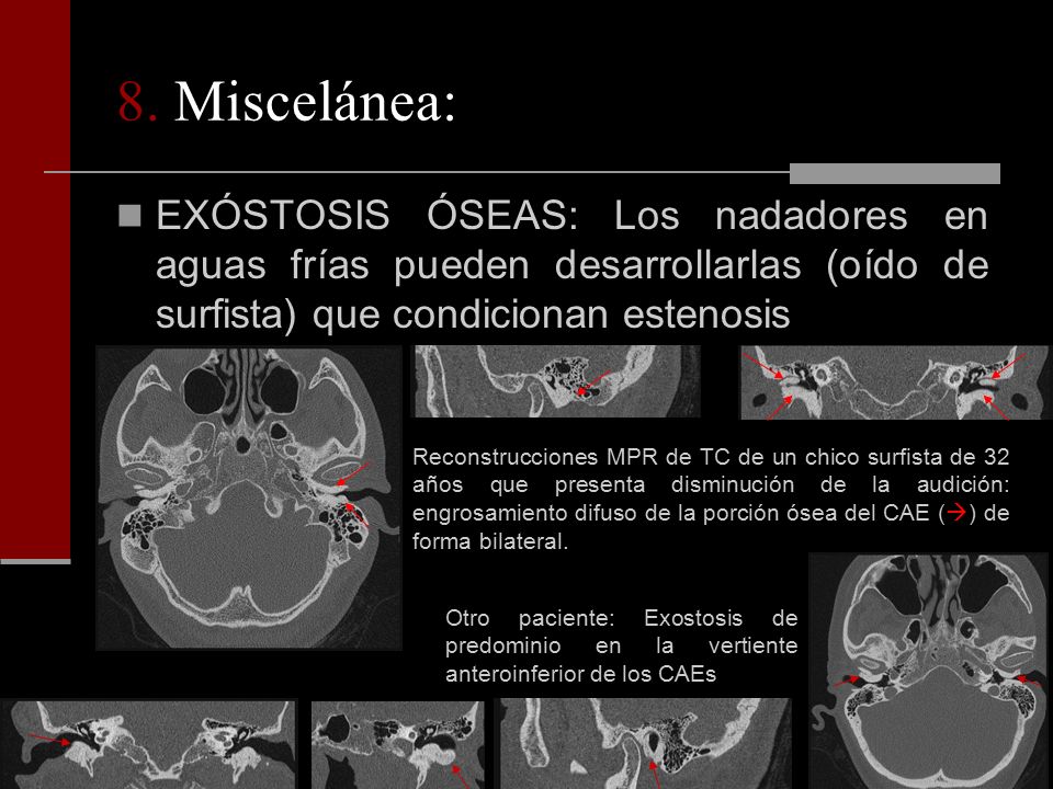 8. Miscelánea: EXÓSTOSIS ÓSEAS: Los nadadores en aguas frías pueden desarrollarlas (oído de surfista) que condicionan estenosis.