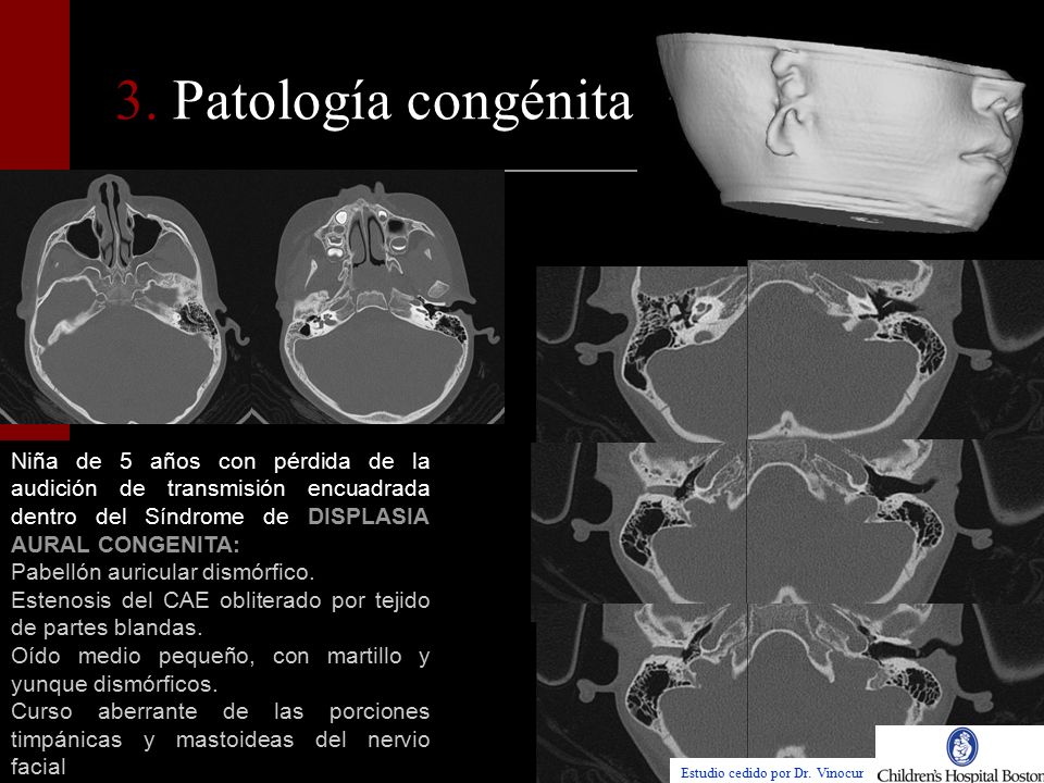 3. Patología congénita: Niña de 5 años con pérdida de la audición de transmisión encuadrada dentro del Síndrome de DISPLASIA AURAL CONGENITA:
