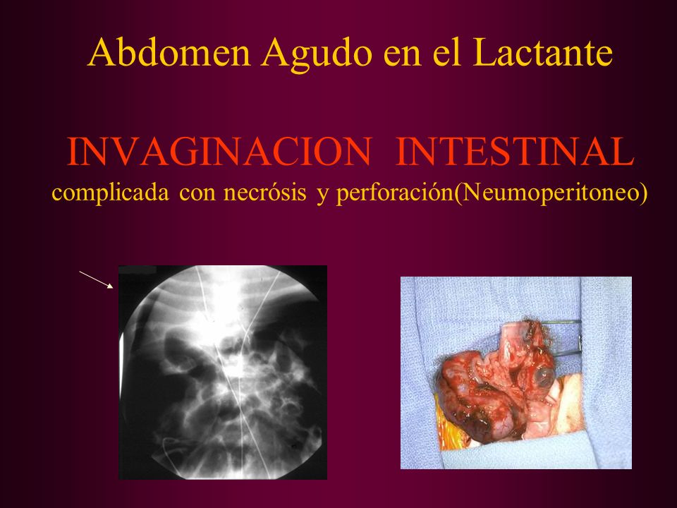 Abdomen Agudo en el Lactante INVAGINACION INTESTINAL complicada con necrósis y perforación(Neumoperitoneo)
