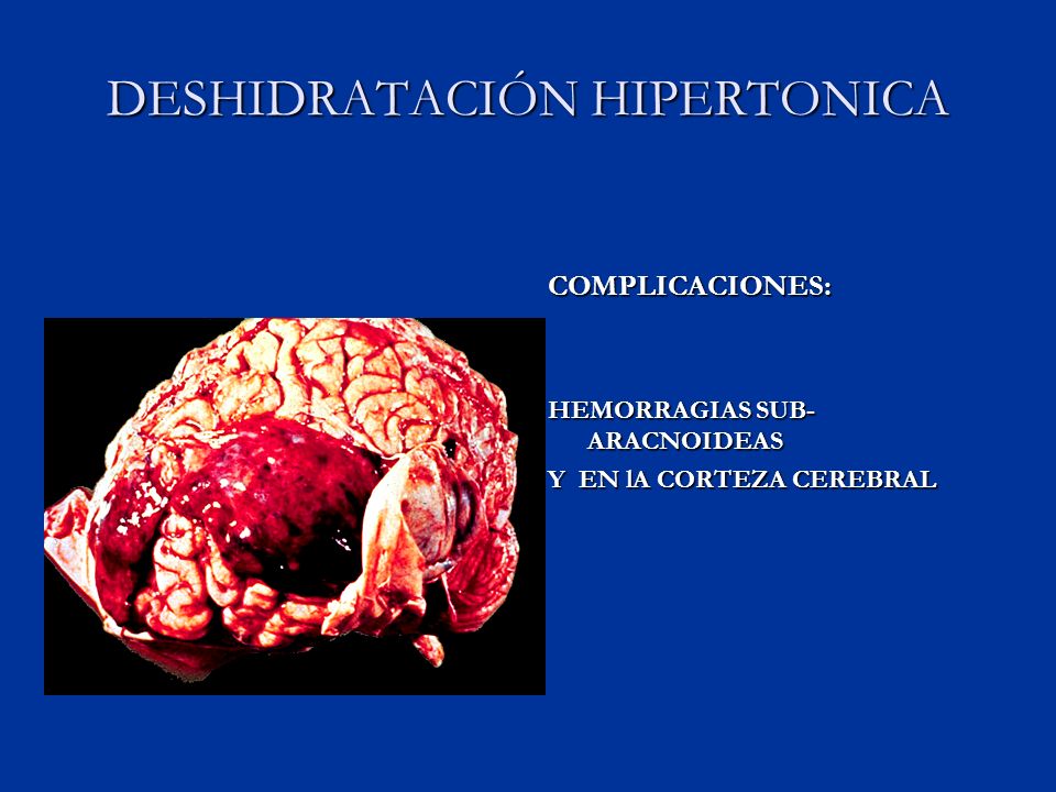 DESHIDRATACIÓN HIPERTONICA