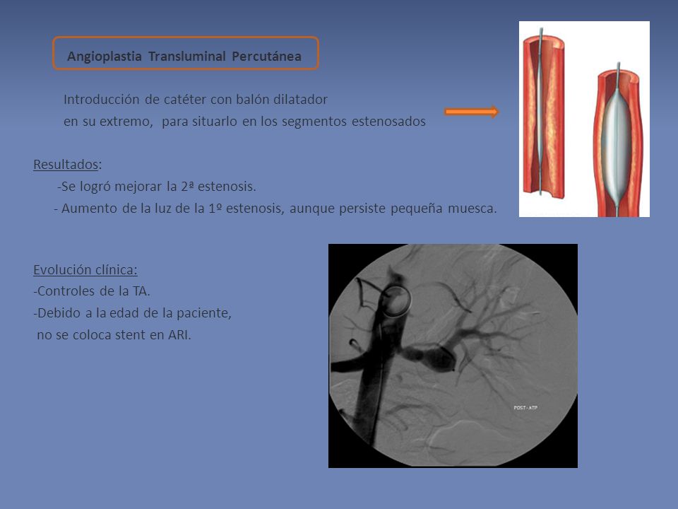 Angioplastia Transluminal Percutánea Introducción de catéter con balón dilatador en su extremo, para situarlo en los segmentos estenosados Resultados: -Se logró mejorar la 2ª estenosis.