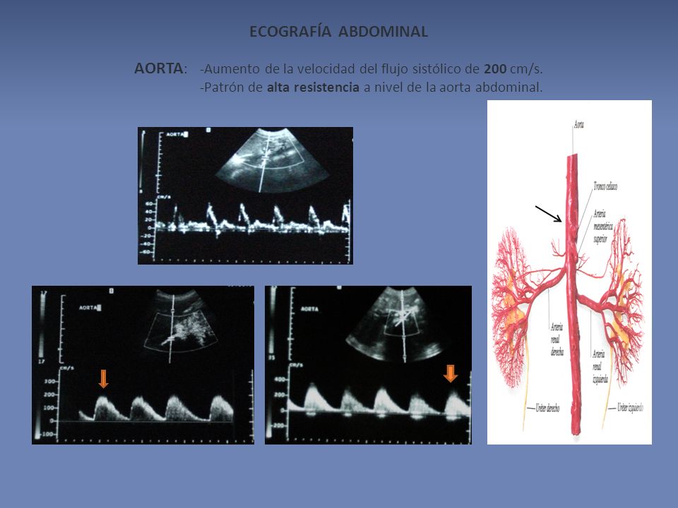 ECOGRAFÍA ABDOMINAL AORTA: -Aumento de la velocidad del flujo sistólico de 200 cm/s.