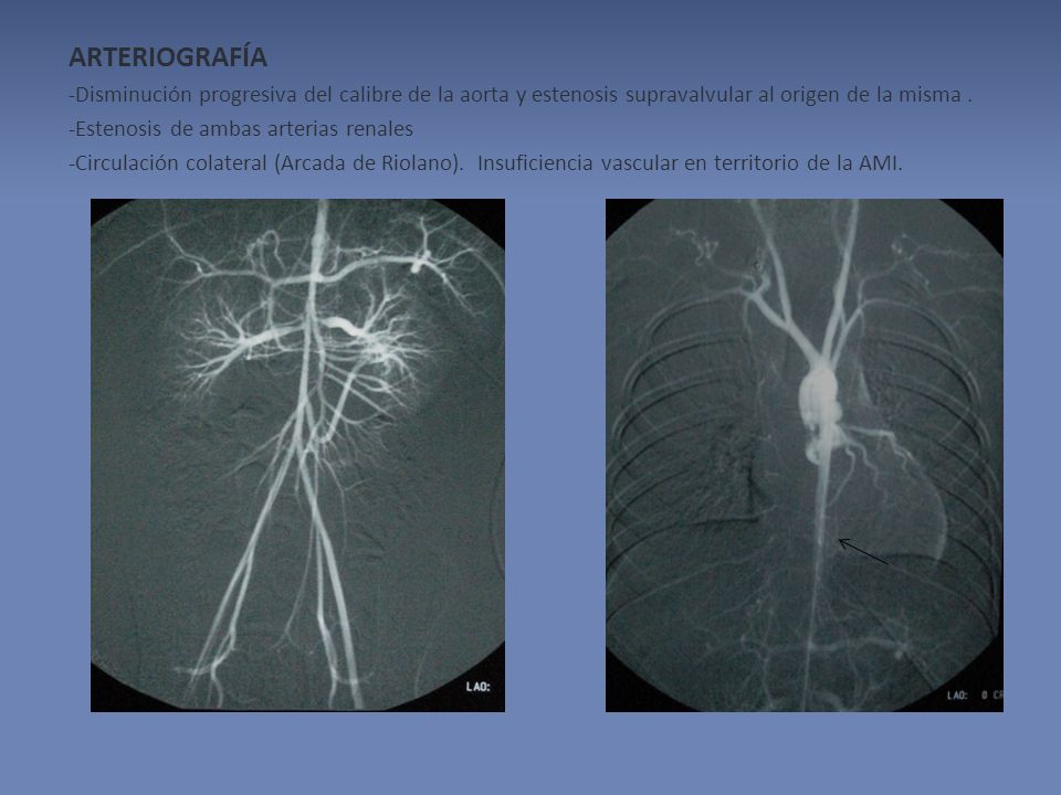 ARTERIOGRAFÍA -Disminución progresiva del calibre de la aorta y estenosis supravalvular al origen de la misma .