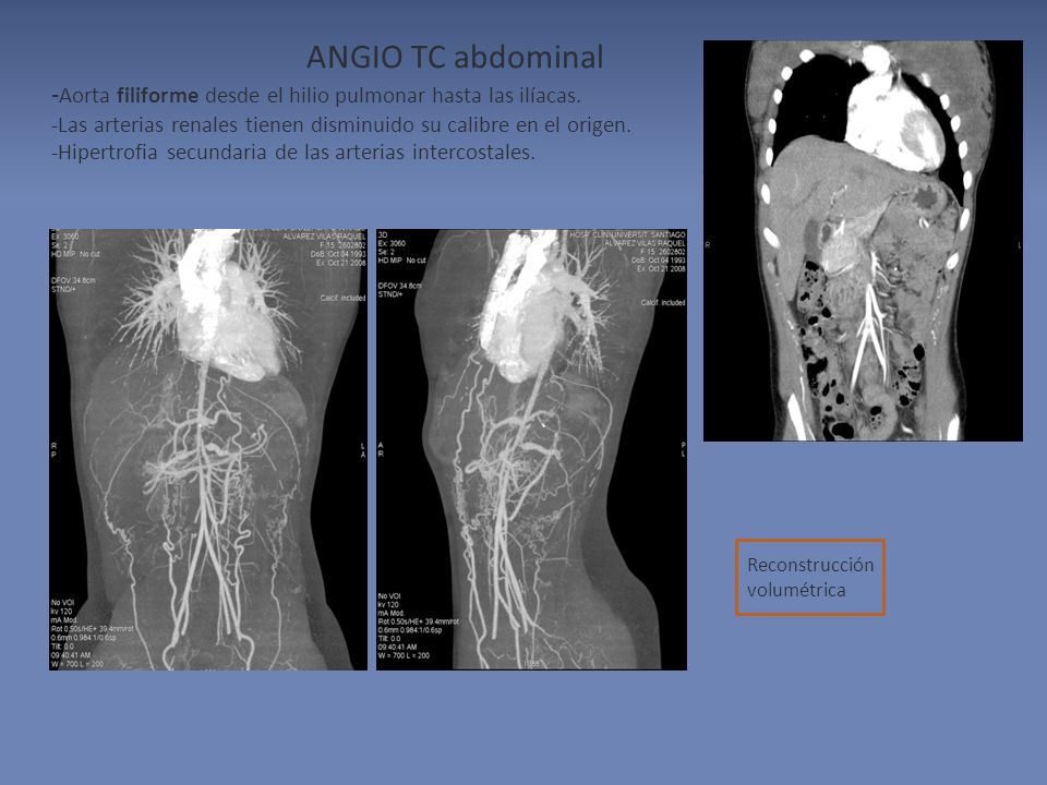 ANGIO TC abdominal -Aorta filiforme desde el hilio pulmonar hasta las ilíacas. -Las arterias renales tienen disminuido su calibre en el origen.