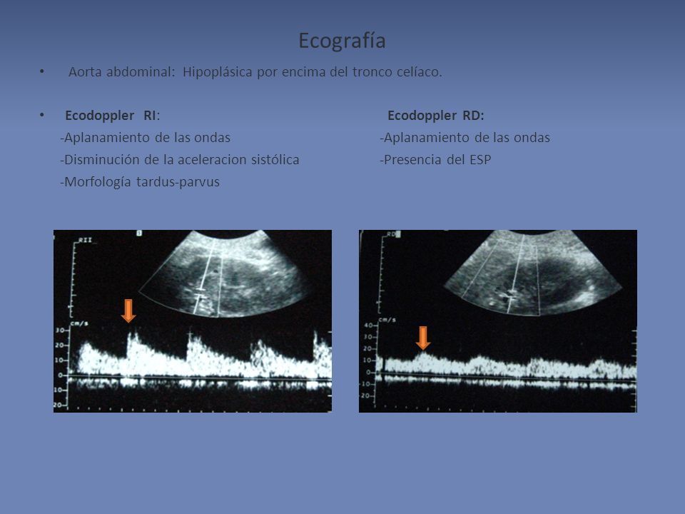 Ecografía Aorta abdominal: Hipoplásica por encima del tronco celíaco.