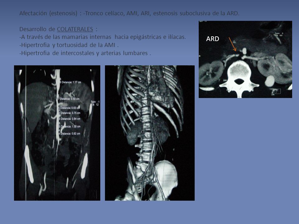 Afectación (estenosis) : -Tronco celíaco, AMI, ARI, estenosis suboclusiva de la ARD. Desarrollo de COLATERALES : -A través de las mamarias internas hacia epigástricas e ilíacas. -Hipertrofia y tortuosidad de la AMI . -Hipertrofia de intercostales y arterias lumbares .