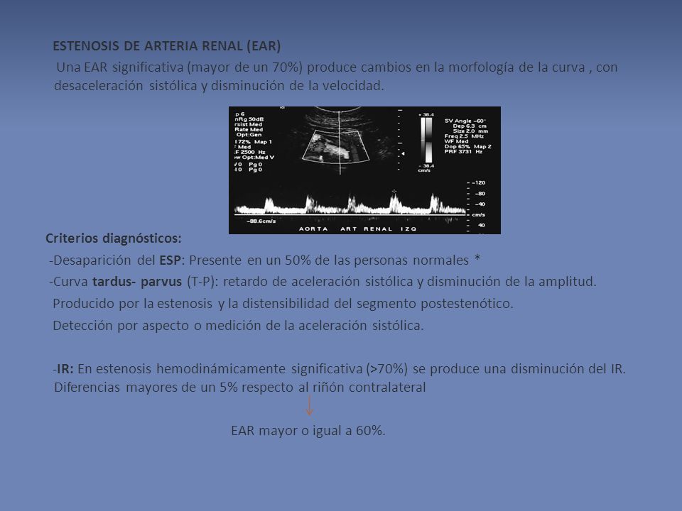 ESTENOSIS DE ARTERIA RENAL (EAR) Una EAR significativa (mayor de un 70%) produce cambios en la morfología de la curva , con desaceleración sistólica y disminución de la velocidad.